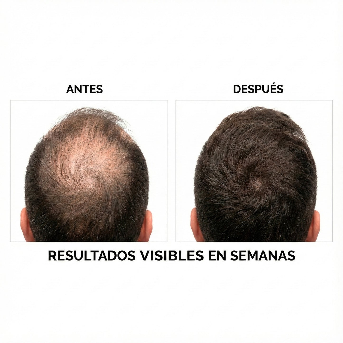 Minoxidil Pro 5% – Volumen, Fuerza y Regeneración Capilar